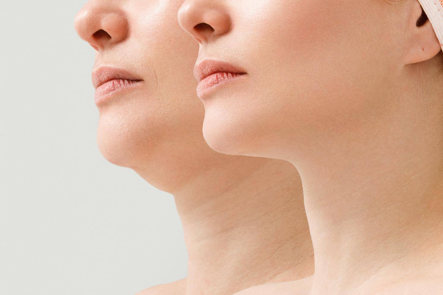 kybella_523647483