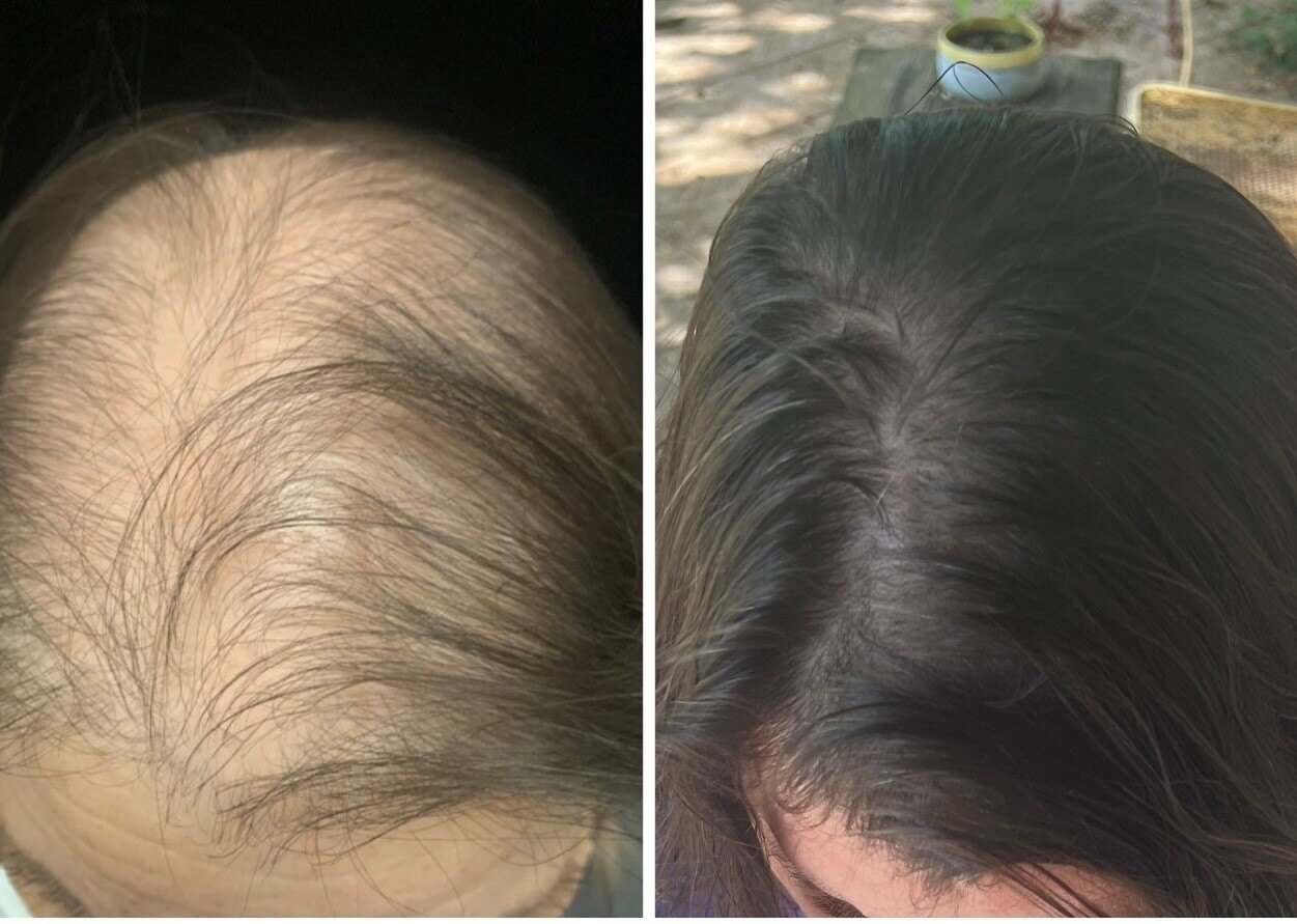 Hair restoration before and after