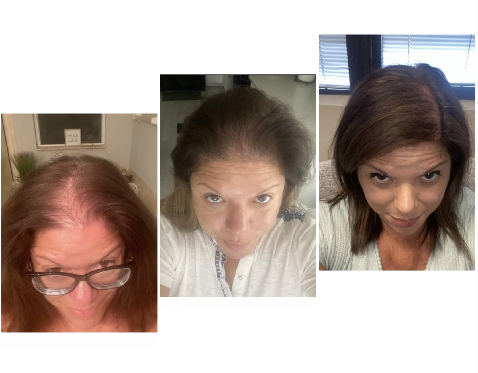 hair restoration woman before and after