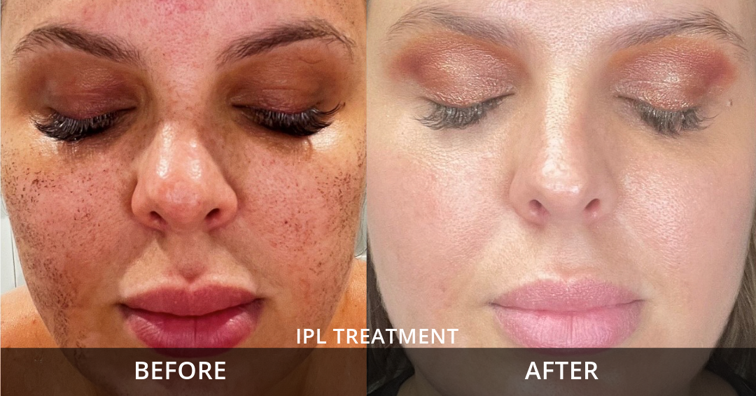 IPL B & A