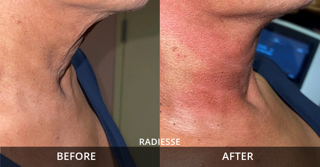 Radiesse B&A