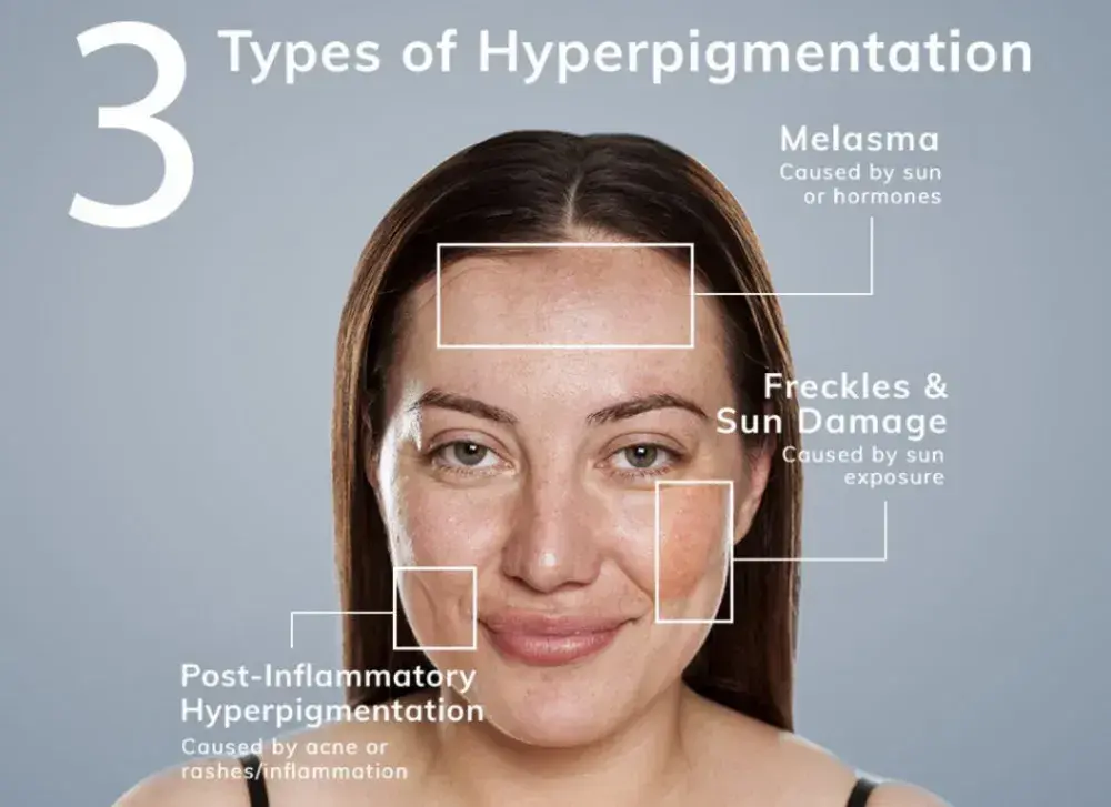 The Doctor Approved Guide to Treating Hyperpigmentation