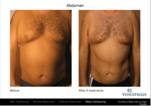 Top 7 Reasons Why Men Are Choosing Venus Freeze