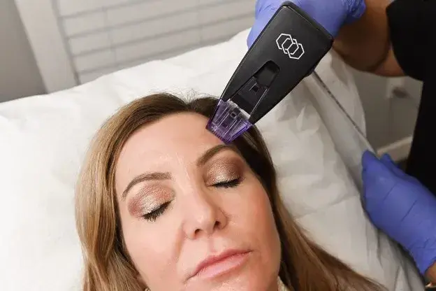 RF Microneedling Morpheus8: Why It’s The Best Skin-Tightening Treatment on The Market