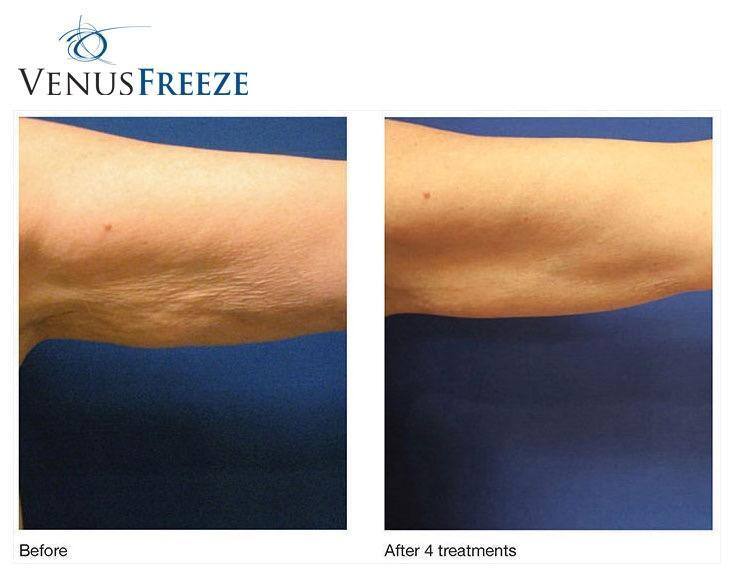 Venus Freeze Skin Tightening