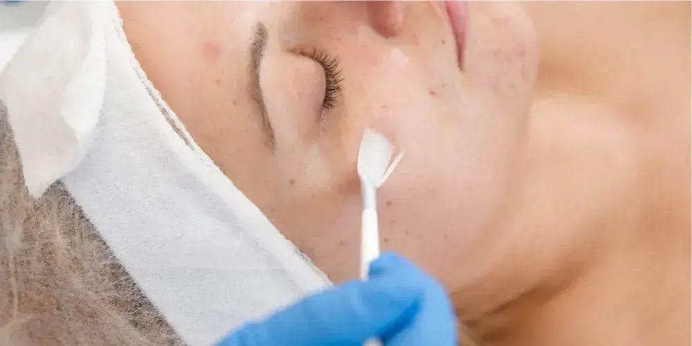 How Do Chemical Peels Work?