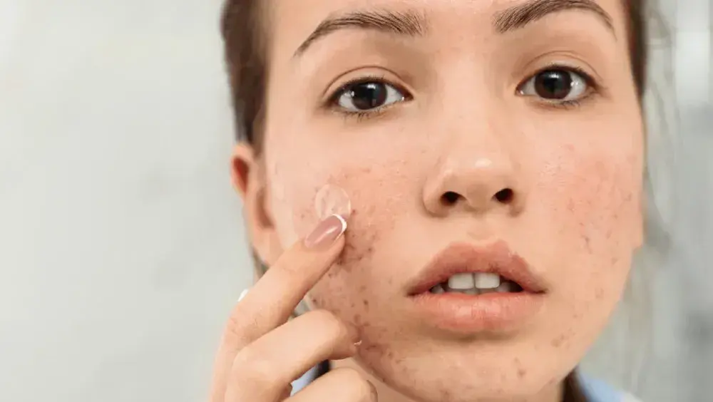 How to Get Clear Skin for Back-to-School Season