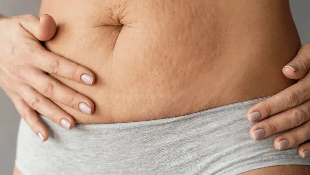 Can You Get Rid of Stretch Marks?