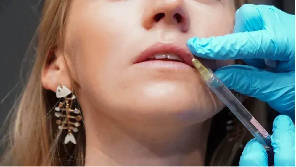 How Long Do Dermal Fillers Last?