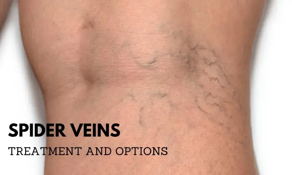 What are Spider Veins and How to Treat Them?